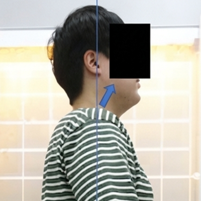 치료사례 썸네일 애프터.png