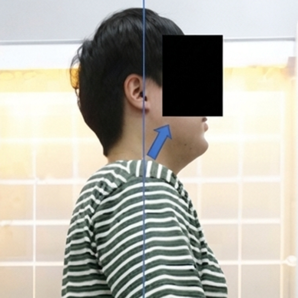 치료사례 썸네일 애프터.png