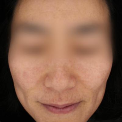 치료사례 썸네일 애프터.png