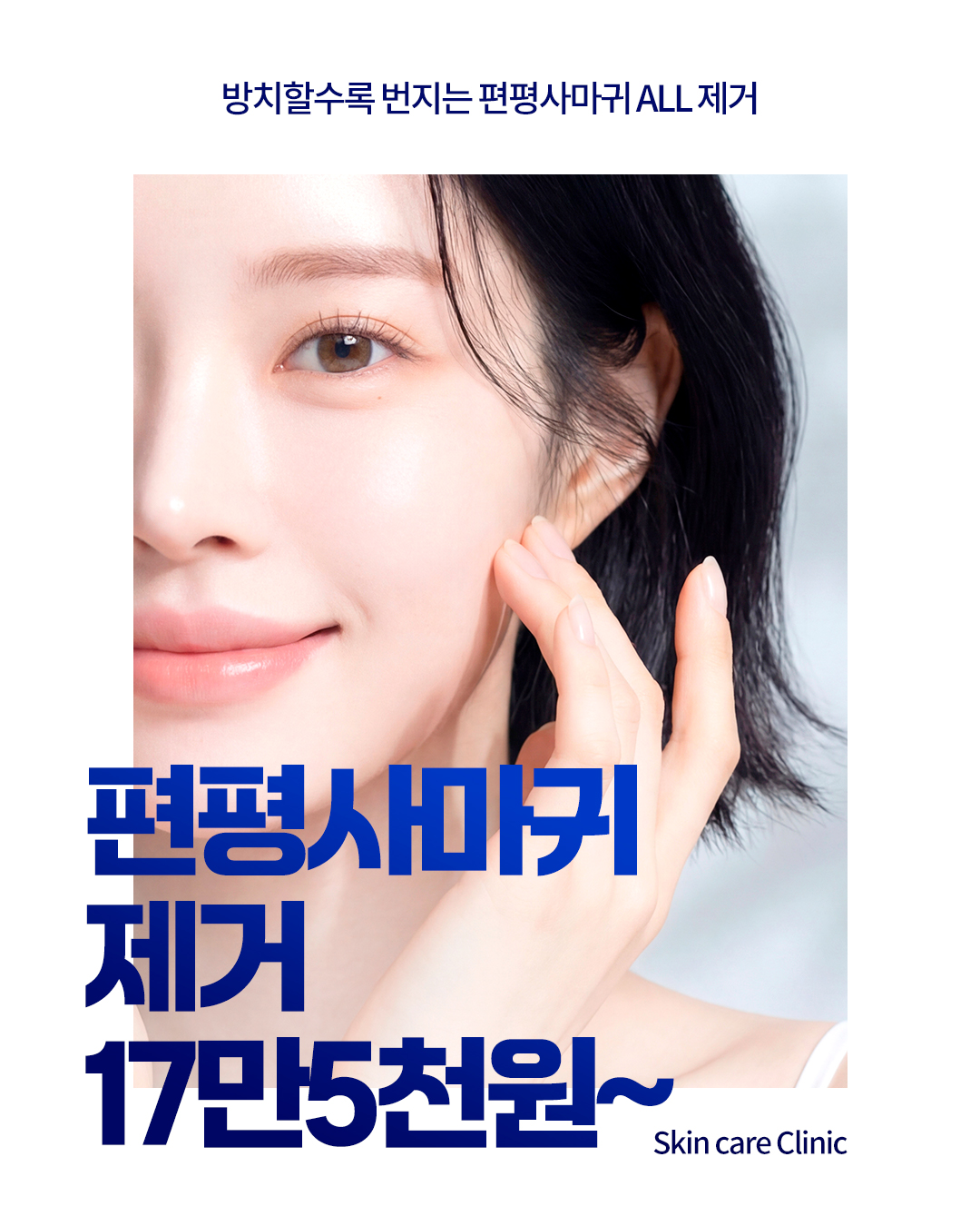 편평사마귀 제거